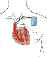 Implantable_Defib.jpg